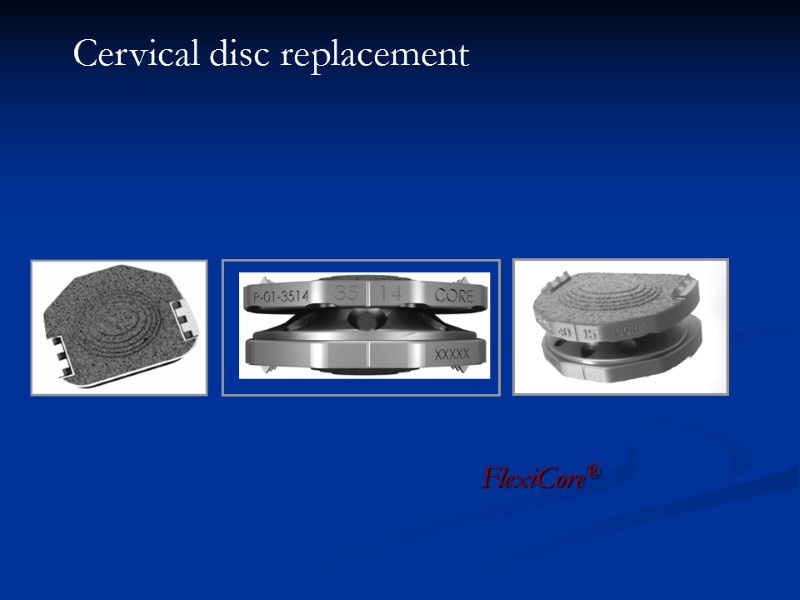 FlexiCore® Cervical disc replacement